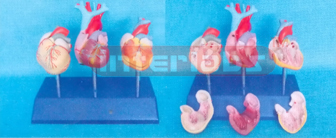 DISEASE HEART VENTRICULAR WITH LEFT VENTRICULAR HYPERTROPHY (LVH)